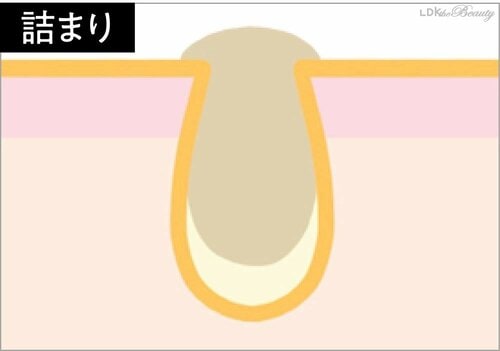 【詰まり】角栓が詰まり触るとザラつく 美容の裏ワザおすすめ イメージ