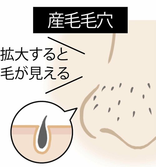毛穴目立ちの原因や毛穴タイプの例 イメージ5
