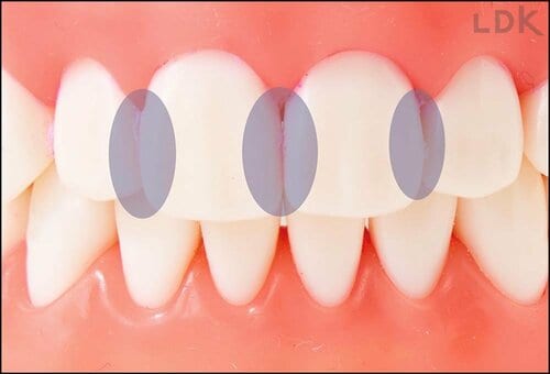 歯と歯のすきま 歯ブラシおすすめ イメージ