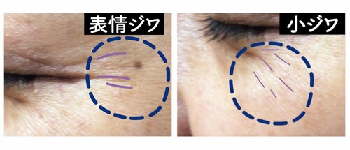 おすすめ:シワ改善はナイアシンアミドが効果的