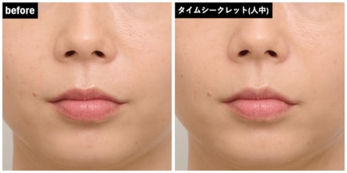 “人中短縮”には不向きかも シェーディングおすすめ イメージ2