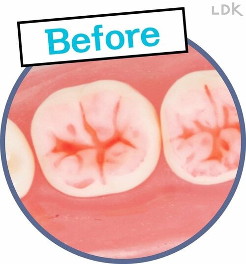 Before 歯ブラシおすすめ イメージ