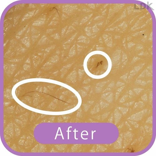 After VIOシェーバーおすすめ イメージ