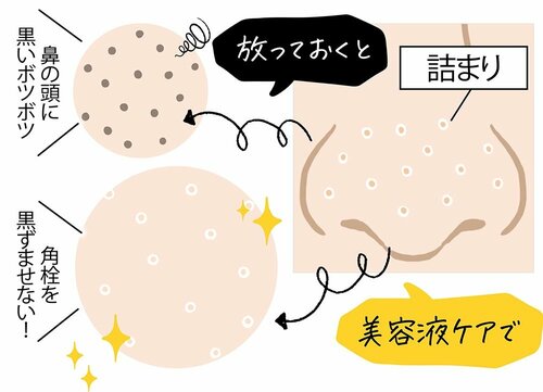 効果1:詰まった角栓の酸化を抑えて黒ずみを防ぐ ビタミンC美容液おすすめ イメージ
