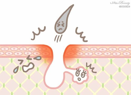 無理やり毛を抜くとさらに悪化 ビタミンC美容液おすすめ イメージ