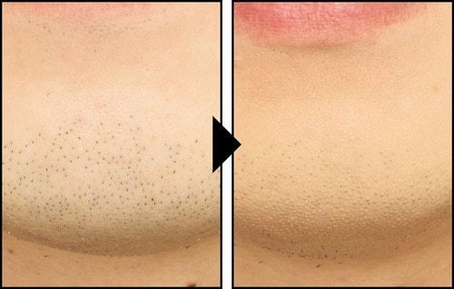 コンシーラーで青ひげを隠した様子