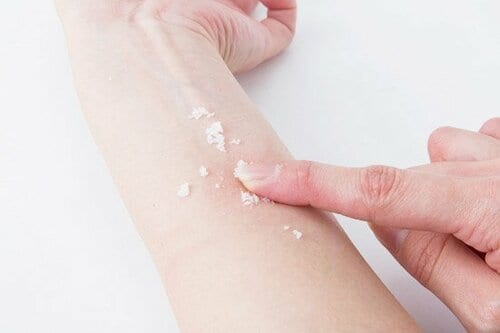 ［裏ワザ②］虫刺されたら「塩」でかゆみ軽減できます イメージ