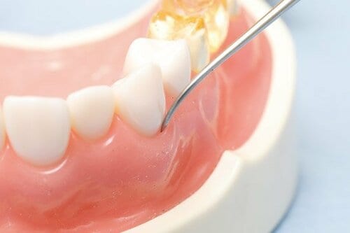 A.歯のチェックやクリーニング。理想は3カ月に1回通院を! オーラルケアおすすめ イメージ
