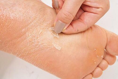 タコ・うおの目ができる原因は？ イメージ