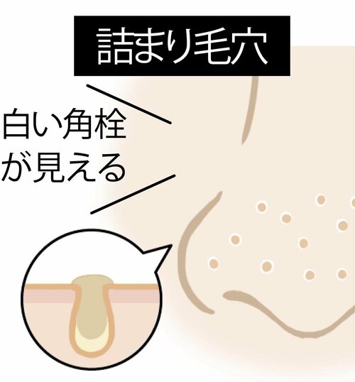 毛穴目立ちの原因や毛穴タイプの例 イメージ