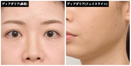 頬ののっぺり感が強調された シェーディングおすすめ イメージ