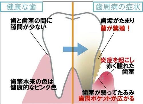 選び方2:歯周病の予防に注目して選ぶ 歯磨き粉おすすめ イメージ