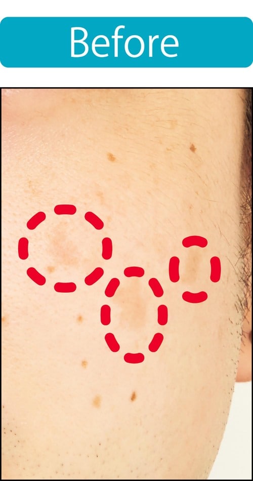 【シミ隠し】“塗った”感がなくナチュラルに補整できた! メンズコンシーラーおすすめ イメージ