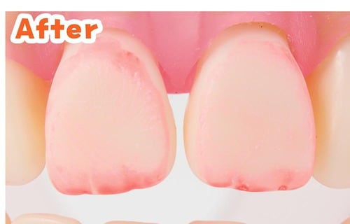 人工歯垢の汚れ落ち:After 歯磨き粉おすすめ イメージ