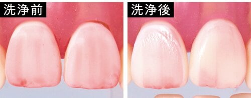 汚れ落ち：人工歯垢を落としきれず ホワイトニング歯磨き粉おすすめ イメージ