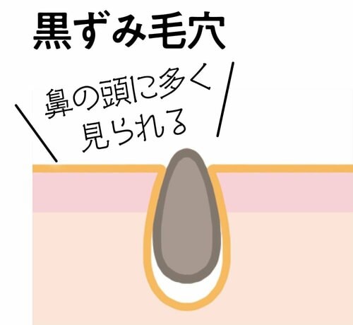 ベストな毛穴ケアとは? ビタミンC化粧水おすすめ イメージ2