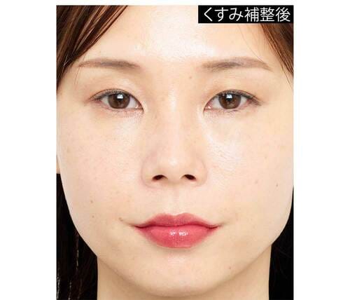 【After】くすみ補正後 青みピンクリップおすすめ イメージ