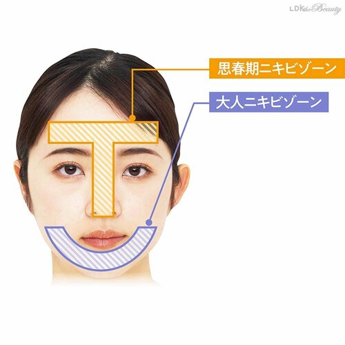 大人ニキビはできる場所と発生原因が違う ニキビケア洗顔料おすすめ イメージ