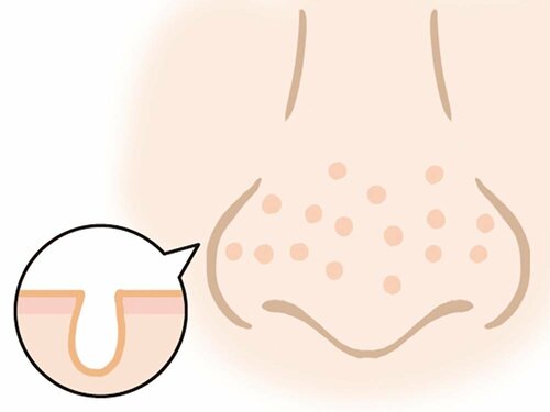 開き毛穴 毛穴クレンジングおすすめ イメージ