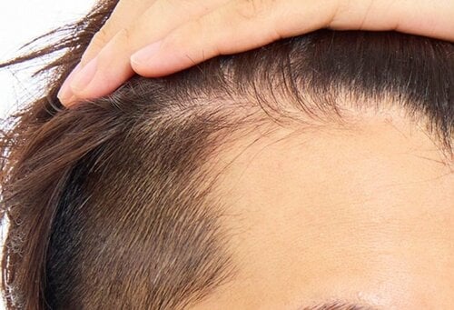 薄毛が気になる生え際