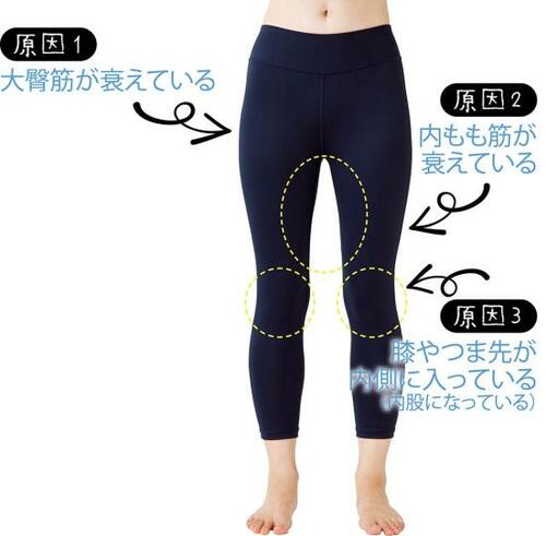O脚って治せないの?