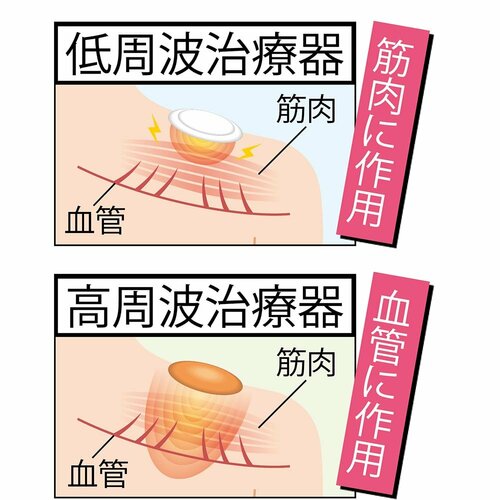 低周波・高周波治療器とは? イメージ2