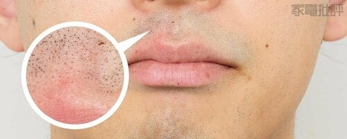 【肌当たり】一発で剃れない箇所はヒリつきが目立った イメージ